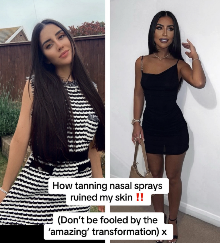 Skin ‘Ruined’ After Tanning & Nasal Spray, Warns Woman