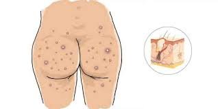 Butt Acne: Causes, Treatment and Prevention